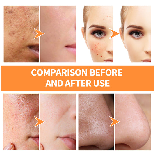 Ginger facial Mask, Acne Removing